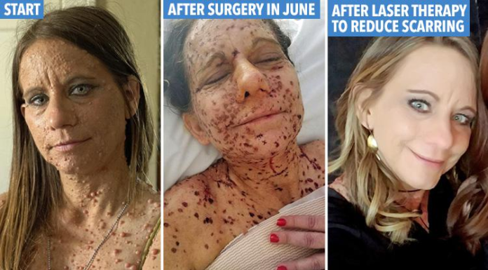 Mum cruelly branded a ‘toad’ due to thousands of tumors covering her body reveals dramatic transformation after undergoing surgery