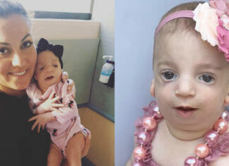 Mom shares touching story of raising a daughter with Treacher Collins Syndrome