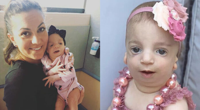 Mom shares touching story of raising a daughter with Treacher Collins Syndrome