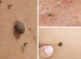 Natural remedies for treating age spots, moles, skin tags, warts, and blackheads