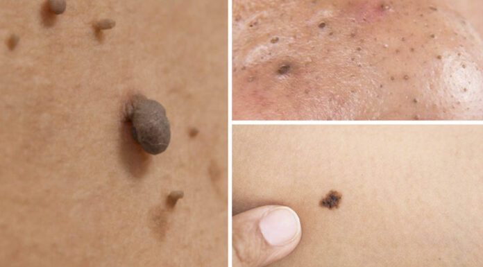 Natural remedies for treating age spots, moles, skin tags, warts, and blackheads