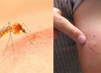 Methods to relieve itching from mosquito bites