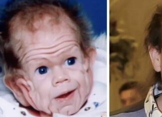 Tomm Tennent: The unique baby born with enough skin to cover the body of a five-year-old child