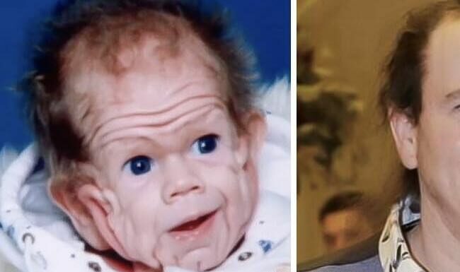 Tomm Tennent: The unique baby born with enough skin to cover the body of a five-year-old child