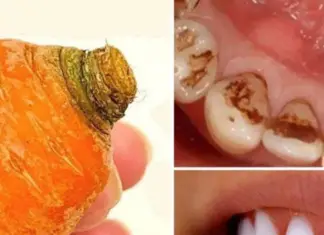 Natural Teeth Whitening – Say Goodbye to Yellowing and Tartar