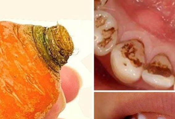 Natural Teeth Whitening – Say Goodbye to Yellowing and Tartar