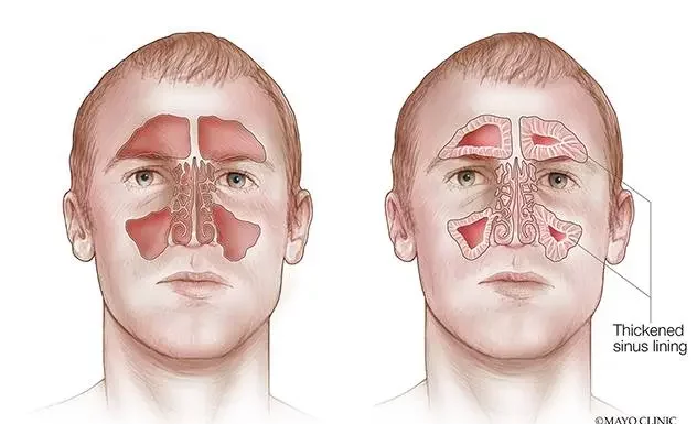 How to Clear Your Sinuses in Seconds with a Simple Self-Massage Technique