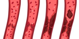 10 Clues Your Body Might Be Giving You About Clogged Arteries