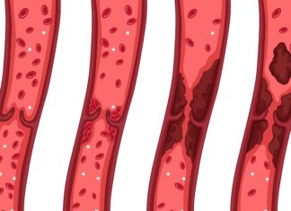 10 Clues Your Body Might Be Giving You About Clogged Arteries