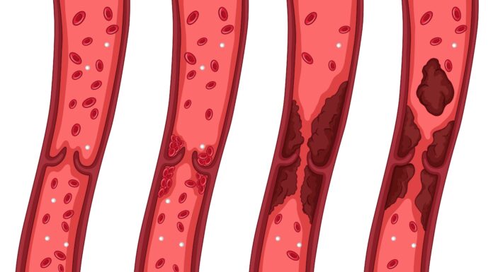 10 Clues Your Body Might Be Giving You About Clogged Arteries
