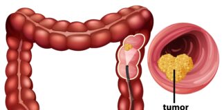 How Your Bowel Movements Reveal Clues About Colon Cancer