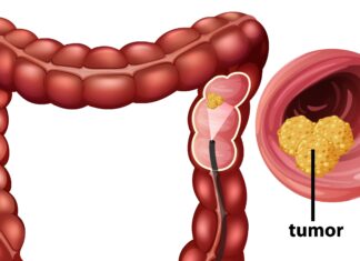 How Your Bowel Movements Reveal Clues About Colon Cancer