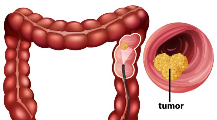 How Your Bowel Movements Reveal Clues About Colon Cancer