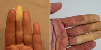 What it actually means if one of your fingers turns white in the cold