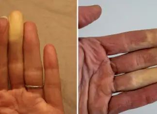 What it actually means if one of your fingers turns white in the cold