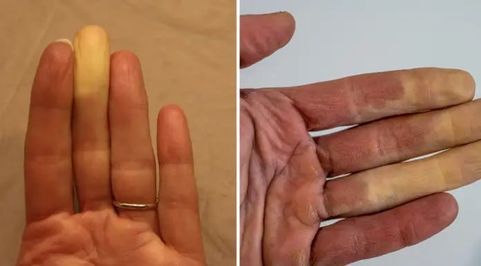 What it actually means if one of your fingers turns white in the cold