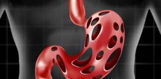 How to Treat H. Pylori Bacteria Causing Heartburn and Bloating + Natural Remedies