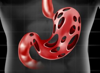 How to Treat H. Pylori Bacteria Causing Heartburn and Bloating + Natural Remedies