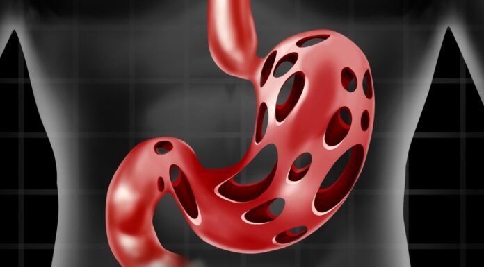 How to Treat H. Pylori Bacteria Causing Heartburn and Bloating + Natural Remedies