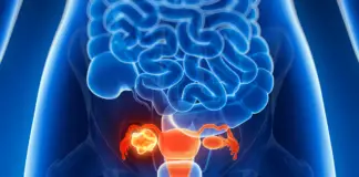 Subtle symptoms of ovarian cancer that shouldn’t be ignored