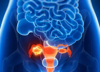 Subtle symptoms of ovarian cancer that shouldn’t be ignored