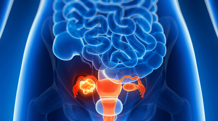 Subtle symptoms of ovarian cancer that shouldn’t be ignored