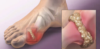 How to help naturally relieve gout and joint pain