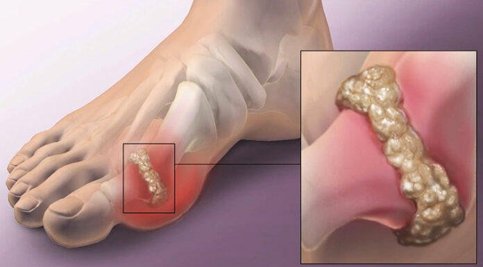 How to help naturally relieve gout and joint pain