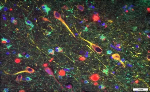 P. gingivalis' gingipains (red) among neurons in the brain of a patient with Alzheimer's.