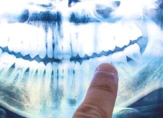 The cause of Alzheimer’s may lie within your mouth