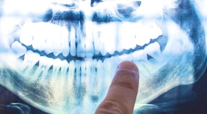 The cause of Alzheimer’s may lie within your mouth