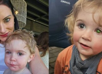 Toddler’s eye ‘melts away’ after he got kissed