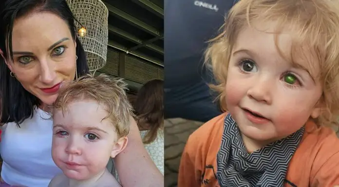 Toddler’s eye ‘melts away’ after he got kissed