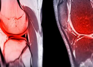 Cutting-edge biomaterial could help repair damaged joint cartilage