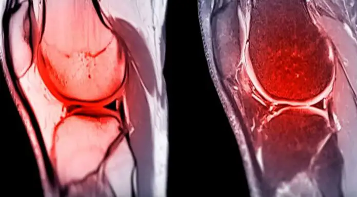 Cutting-edge biomaterial could help repair damaged joint cartilage