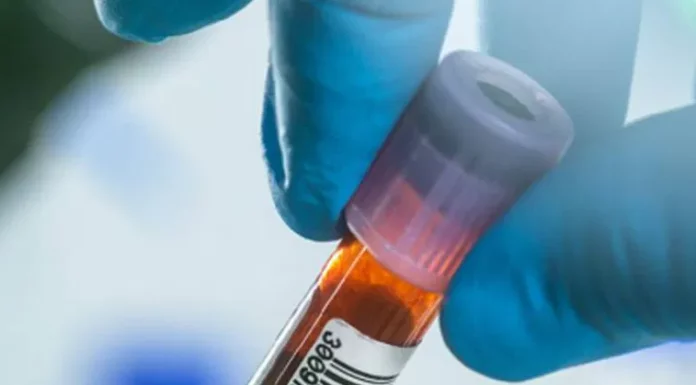 Doctors identify the blood type most at risk for developing stomach cancer