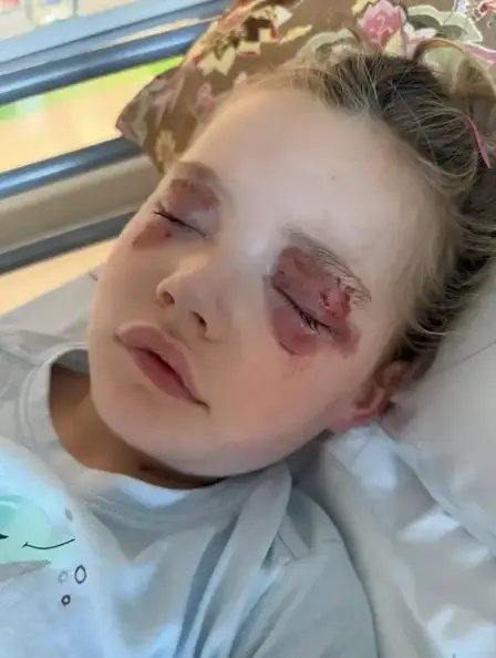 The girl was helping her mom with the laundry when she bit into the washing pod that burst into her face, leaving her temporarily blinded.