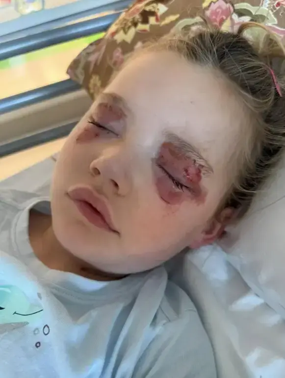 The girl was helping her mom with the laundry when she bit into the washing pod that burst into her face, leaving her temporarily blinded.