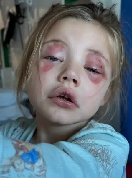 The girl was helping her mom with the laundry when she bit into the washing pod that burst into her face, leaving her temporarily blinded.