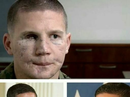 I hid my face for years – until the day I received the medal