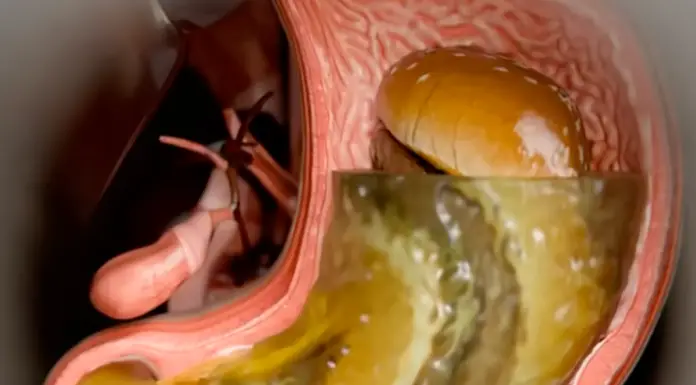 Simulation reveals harsh effects of Ozempic on the body