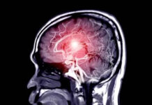 12 signs that may signal a brain aneurysm — Don’t ignore them