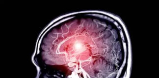 12 signs that may signal a brain aneurysm — Don’t ignore them