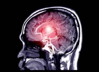 12 signs that may signal a brain aneurysm — Don’t ignore them