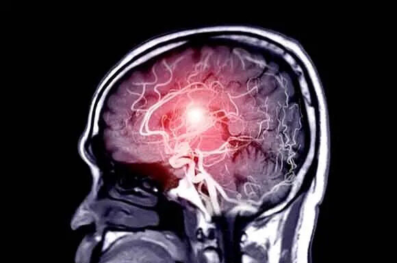 12 signs that may signal a brain aneurysm — Don’t ignore them