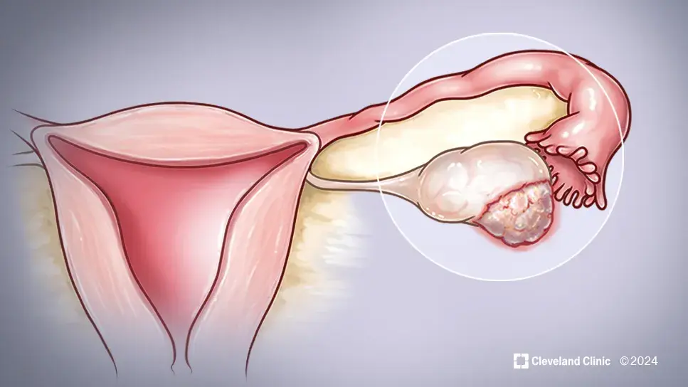 The link between ovarian and breast cancer.