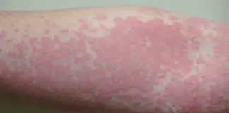 What’s really causing your hives? Uncover these unexpected triggers