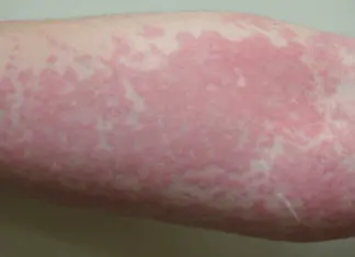 What’s really causing your hives? Uncover these unexpected triggers