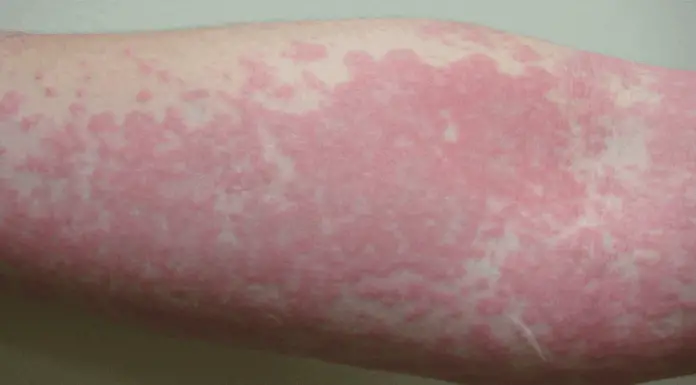 What’s really causing your hives? Uncover these unexpected triggers