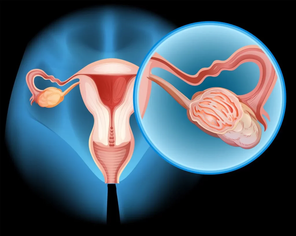 The link between ovarian and breast cancer.